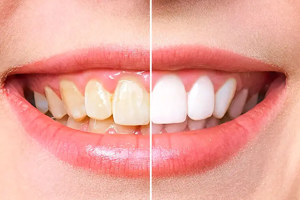 Affordable Professional Teeth Whitening at White Pearl Dental in Vaughan, Ontario
