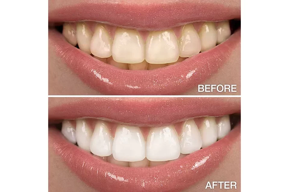 Best Alternatives to Coconut Oil Teeth Whitening