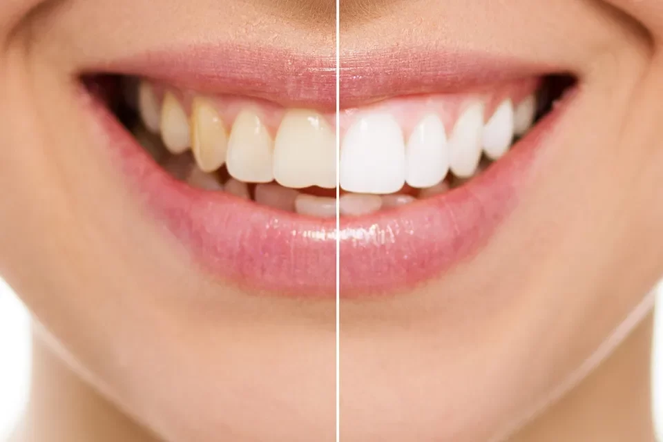 How Long Does Teeth Whitening Take to See Results