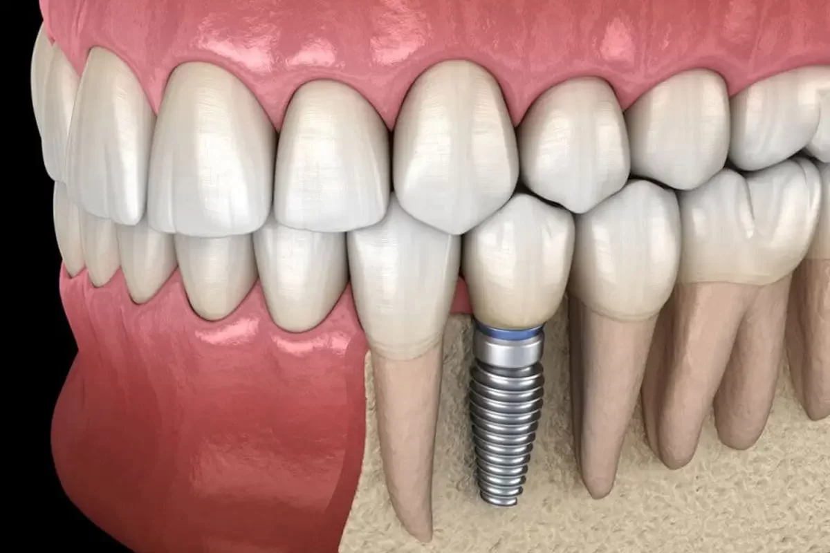 WP-DentalImplants-004