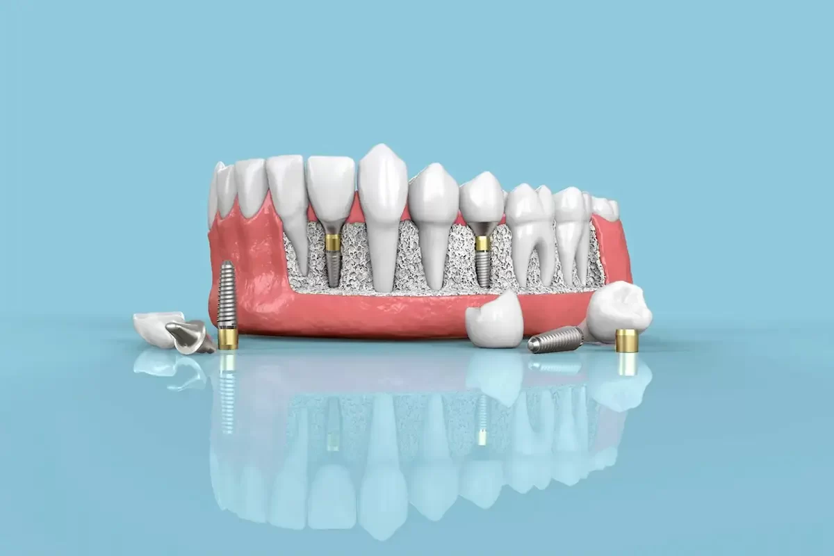 WP-DentalImplants-005